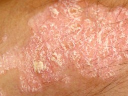 Se la psoriasi che il dottore rivolgersi